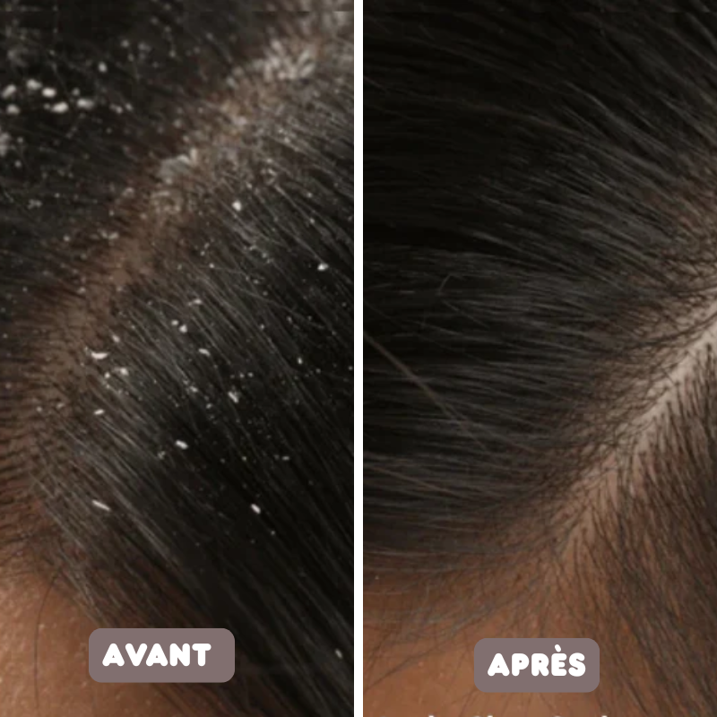 Peigne Anti-Pellicules Auto-nettoyant & Antistatique