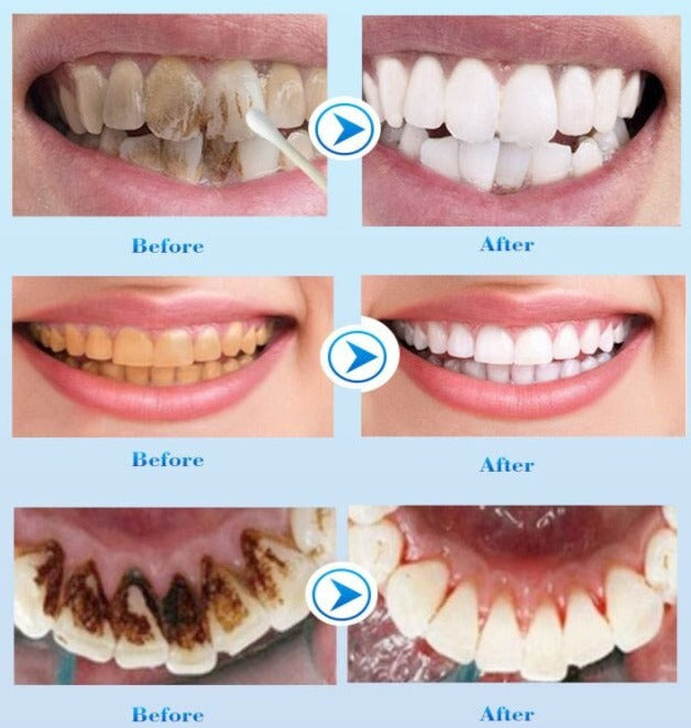 Dentifrice Blanchissant