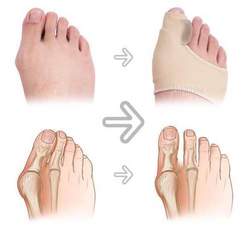 Paire correctrice pour hallux valgus
