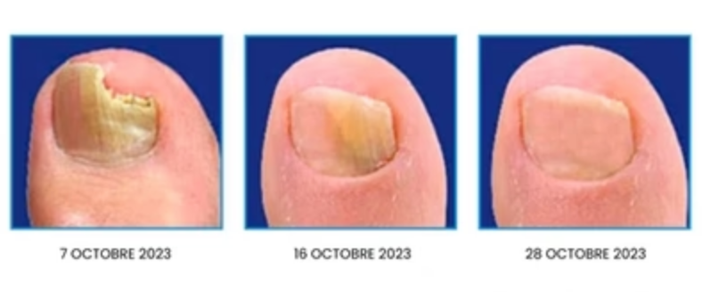 Appareil de traitement au laser pour champignon des ongles