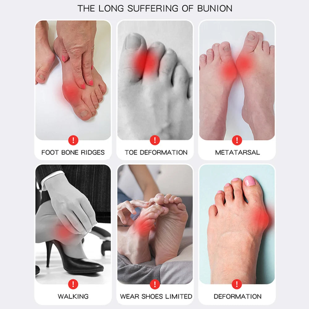 Correcteur d'orteils Hallux Valgus - Confort Quotidien