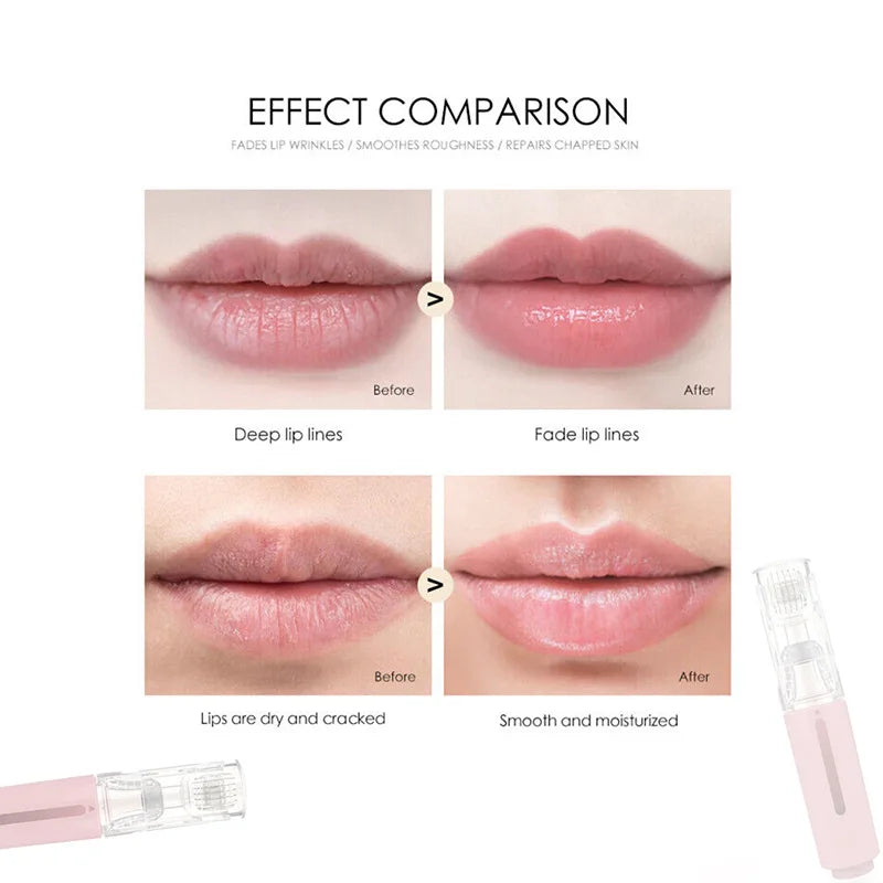 HYDRALIPS - Dermaroller microneedling pour hydrater et repulper vos lèvres